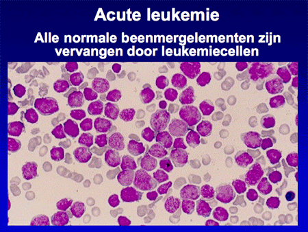 Acute lymfatische leukemie (ALL) dia 4