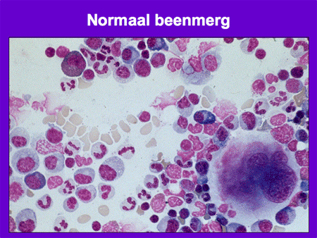 Acute myeloïde leukemie (AML incl. APL) dia 3