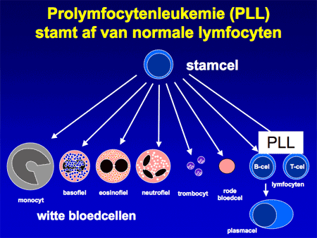 Prolymfocytenleukemie (PLL) dia 4