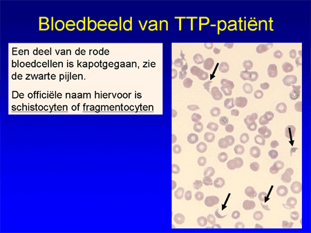Trombotische trombocytopenische purpura (TTP) dia 7