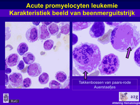 Acute myeloïde leukemie (AML incl. APL) promyelocyten 03