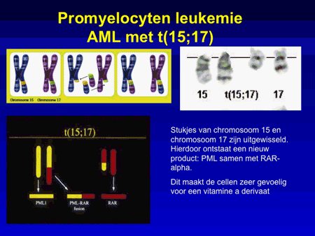Acute myeloïde leukemie (AML incl. APL) promyelocyten 04