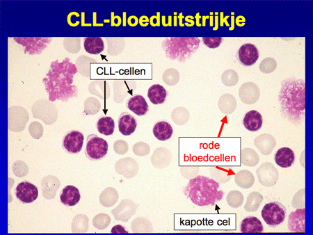 Chronisch Lymfatische Leukemie (CLL) dia 5