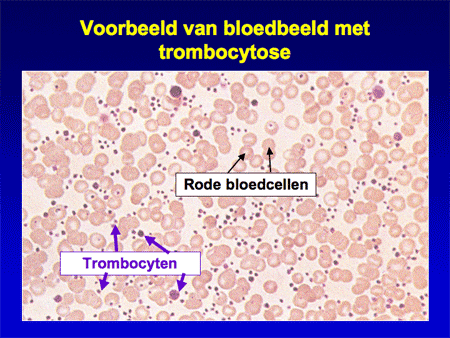 Essentiële trombocytemie (ET) dia 5