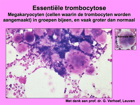 Essentiële trombocytemie (ET) dia 8