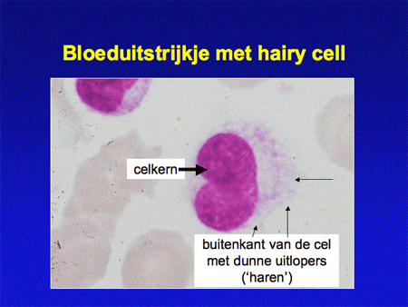 Hairy cell leukemie (HCL) dia 2
