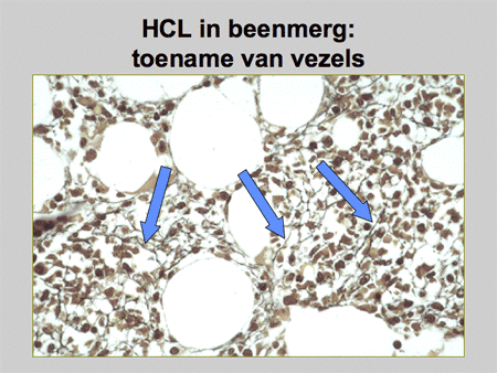 Hairy cell leukemie (HCL) dia 11