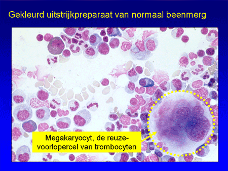Immuun trombocytopenische purpura (ITP) dia 4