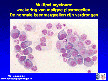 Multipel myeloom / ziekte van Kahler dia 15