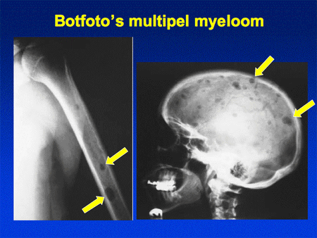 Multipel myeloom / ziekte van Kahler dia 17