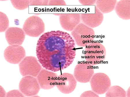Eosinofiele bloedziekten dia 3