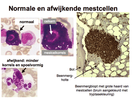 Mastocytose (mestcelziekte) dia 2