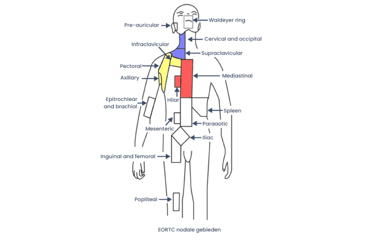 Hodgkin Lymfoom - Hematologie Groningen